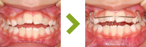 歯並び症例