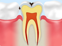 C1：初期虫歯
