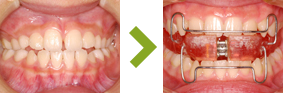 歯並び症例