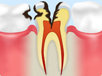 C3：歯の神経まで達した虫歯